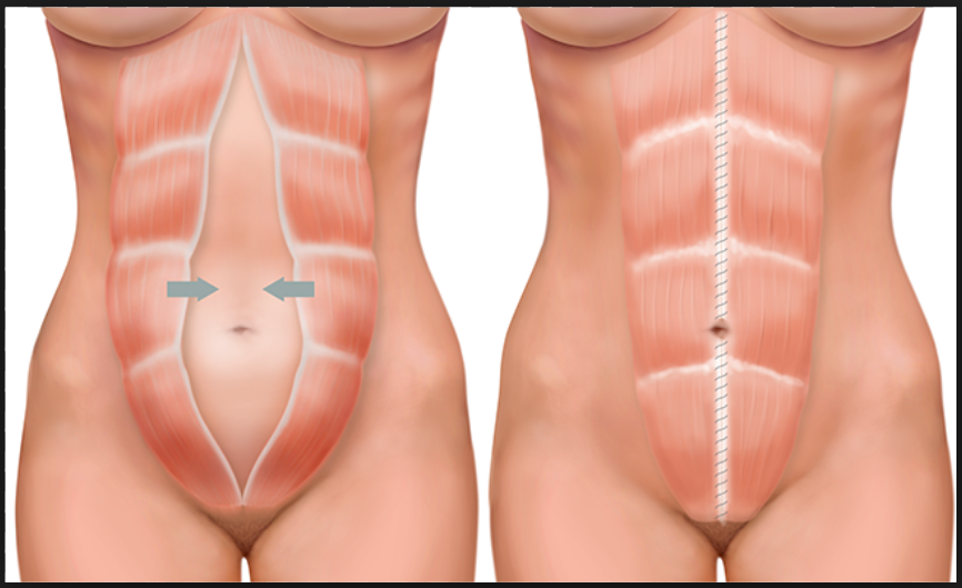 Como fazer o auto-exame da diástase abdominal? - Viva Fisio